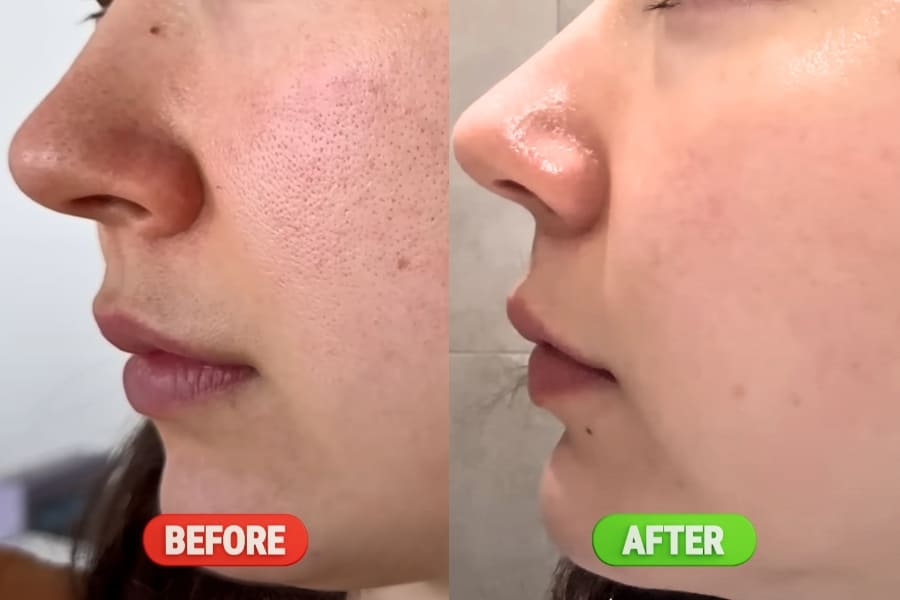 My skin dryness and acne are gone after drinking hydrogen water from Echo Flask